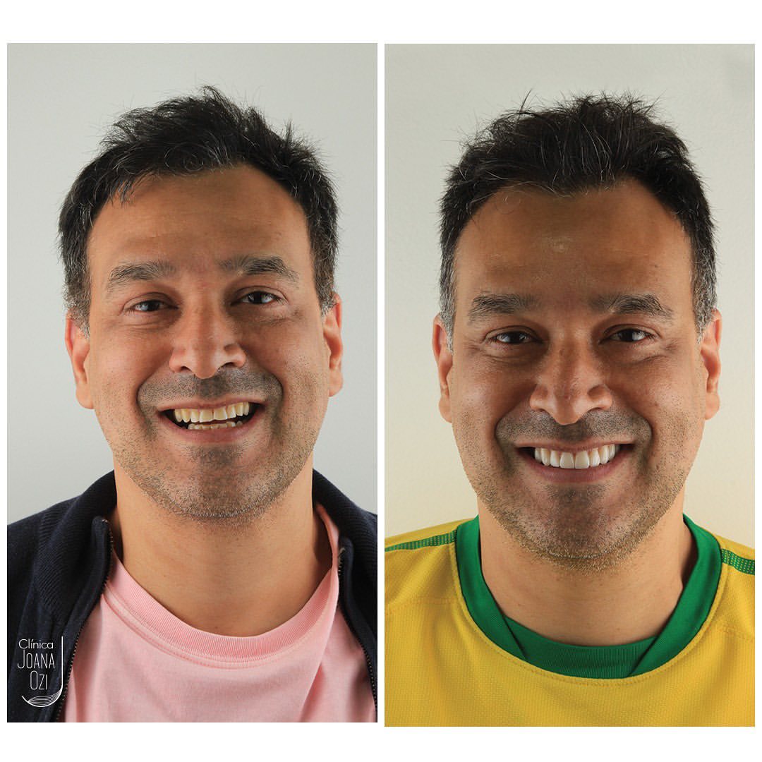 Antes e depois de lente de contato dental, caso real da Clínica Joana Ozi mostrando o rosto do paciente