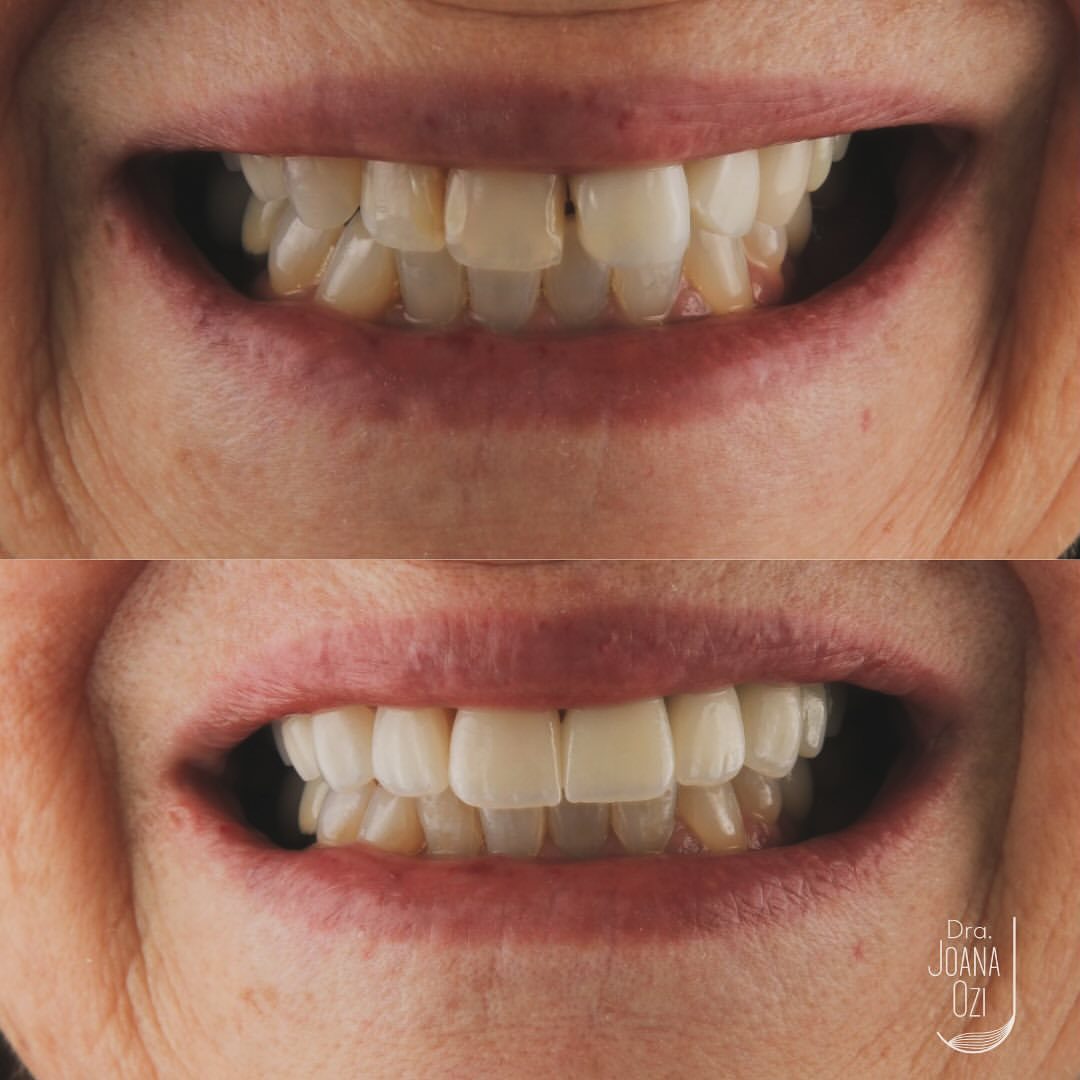 Antes e depois da reabilitação oral com implantes, coroas e lentes, vistos de frente, caso real da Clínica Joana Ozi