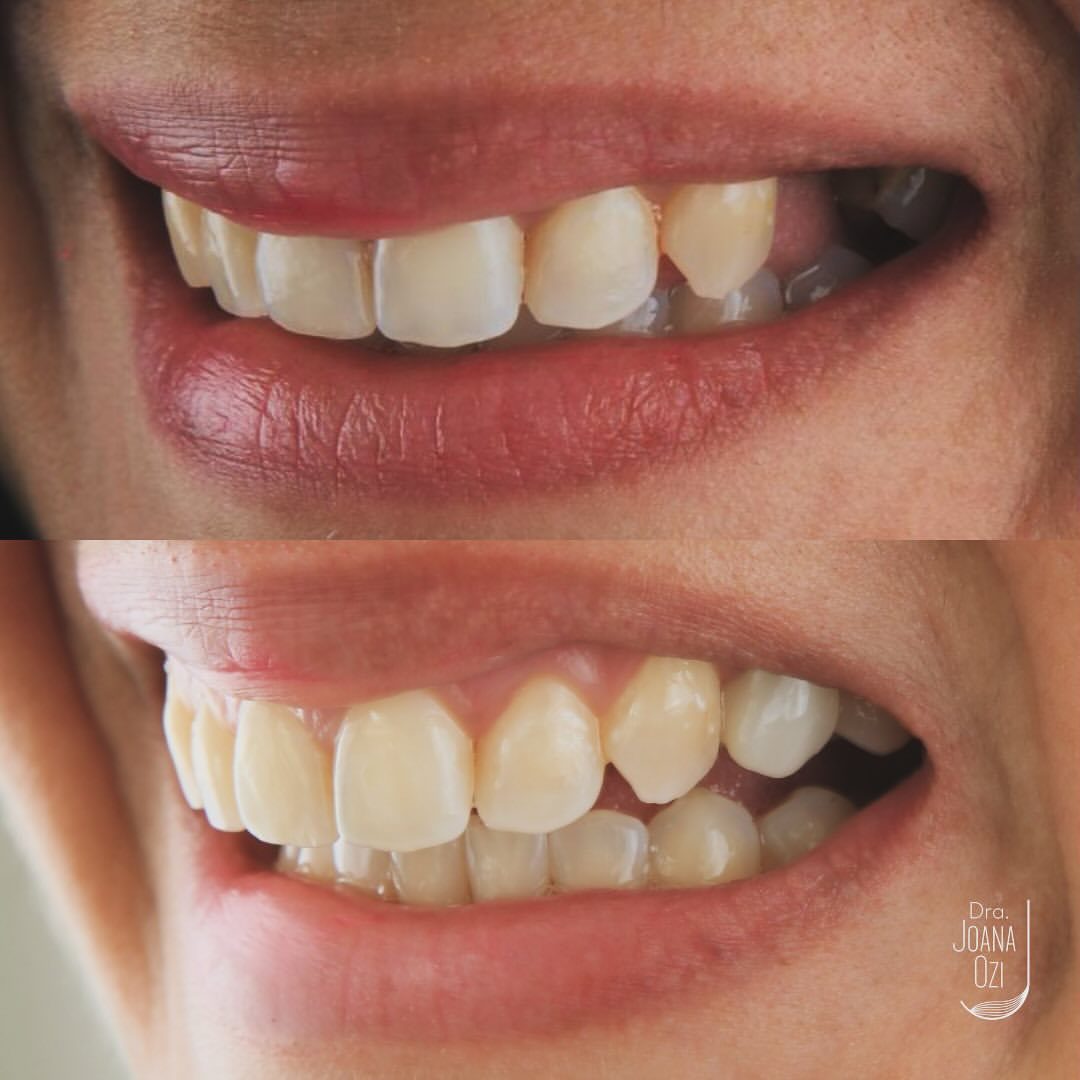 Antes e depois da prótese sobre implante, caso real da Clínica Joana Ozi