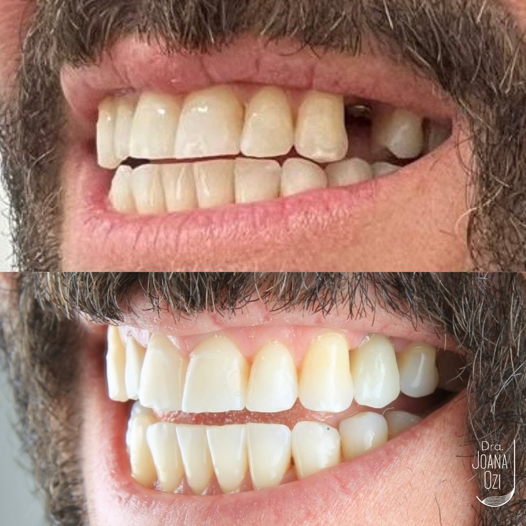 Antes e depois de reabilitação com implante, caso real da Clínica Joana Ozi