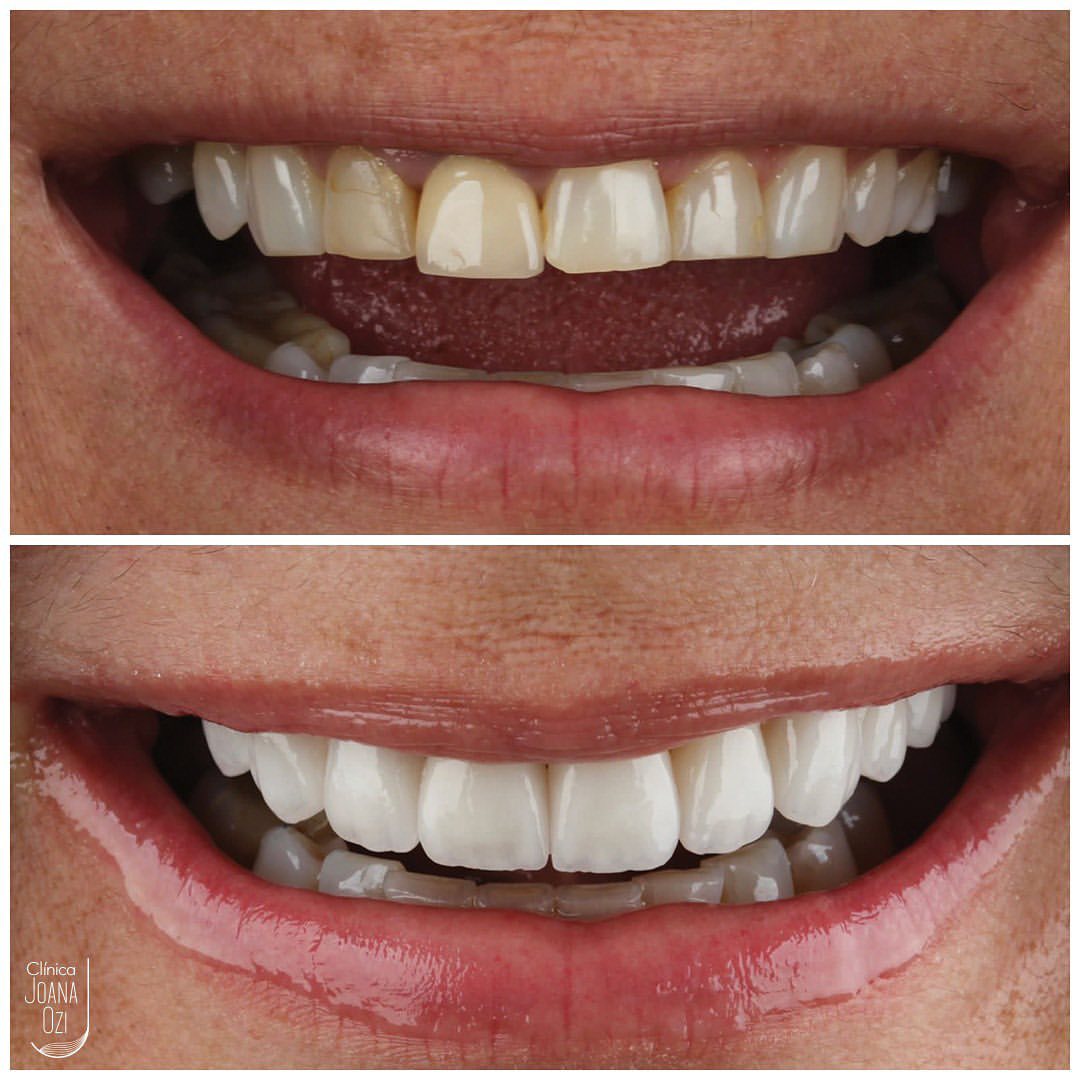Antes e depois de lentes de contato dental no arco superior, caso real da Clínica Joana Ozi