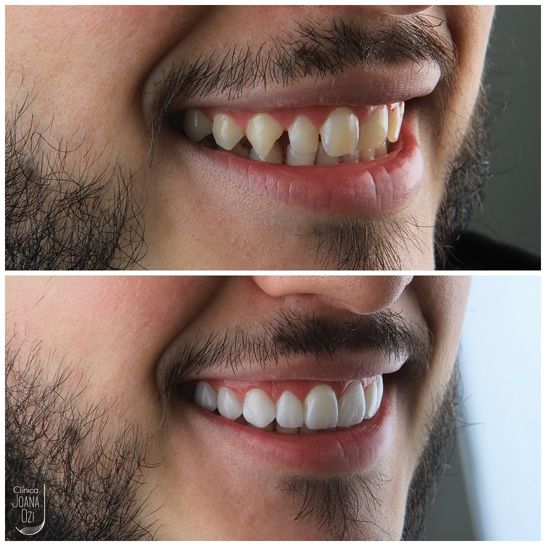 Antes e depois de lentes de contato dental com mudança de forma e cor, caso real da Clínica Joana Ozi