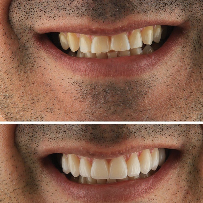 Antes e depois de lentes de contato dental, caso real da Clínica Joana Ozi