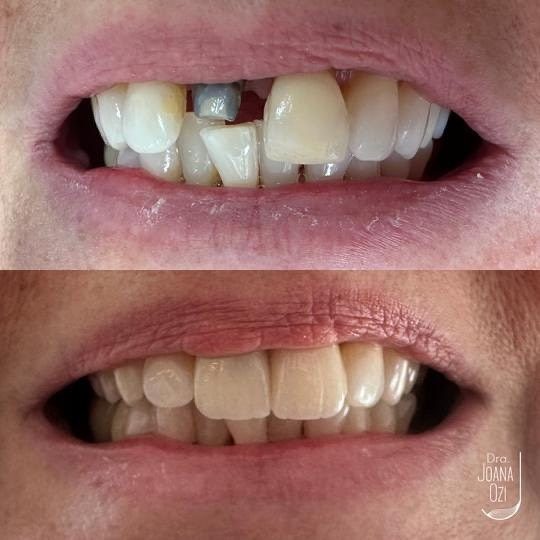 Antes e depois de coroa de porcelana e laminado nos dentes da frente, caso real da Clínica Joana Ozi