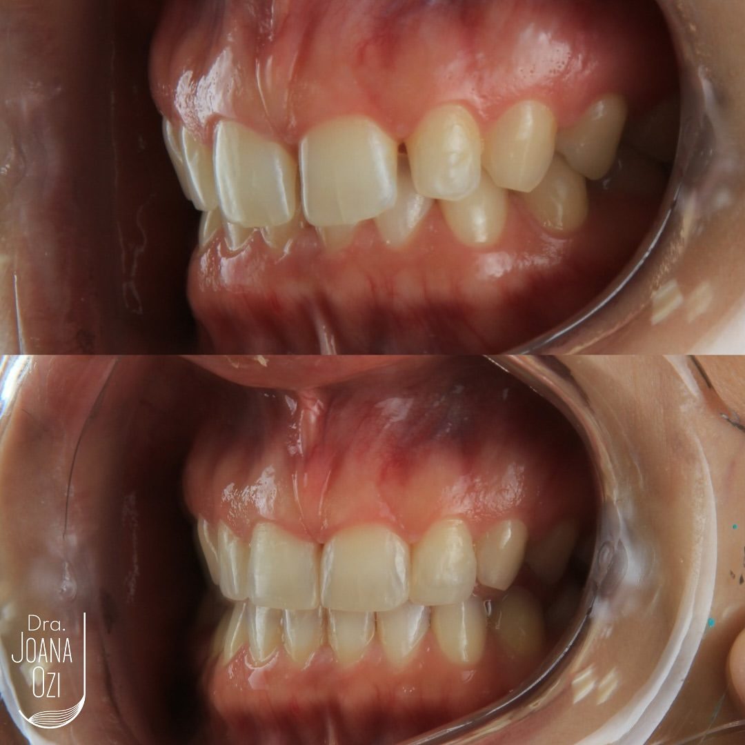 Antes e depois de restauração em resina nos dentes anteriores, caso real da Clínica Joana Ozi