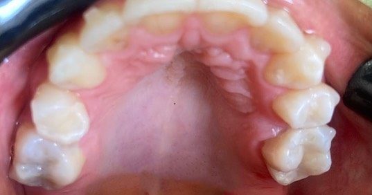 Dentes depois da troca de restaurações de amálgama feita com sedação, caso real da Clínica Joana Ozi